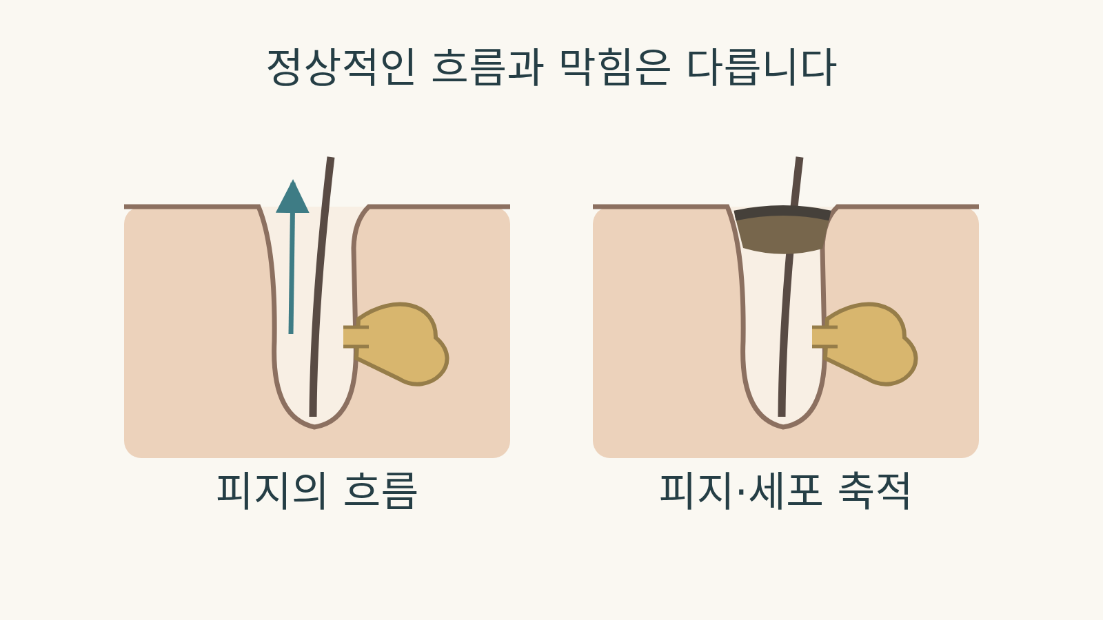 모낭 옆 피지샘에서 이어지는 통로와 위쪽 피지 흐름, 모낭 입구에 내용물이 쌓인 상태를 비교한 개념도